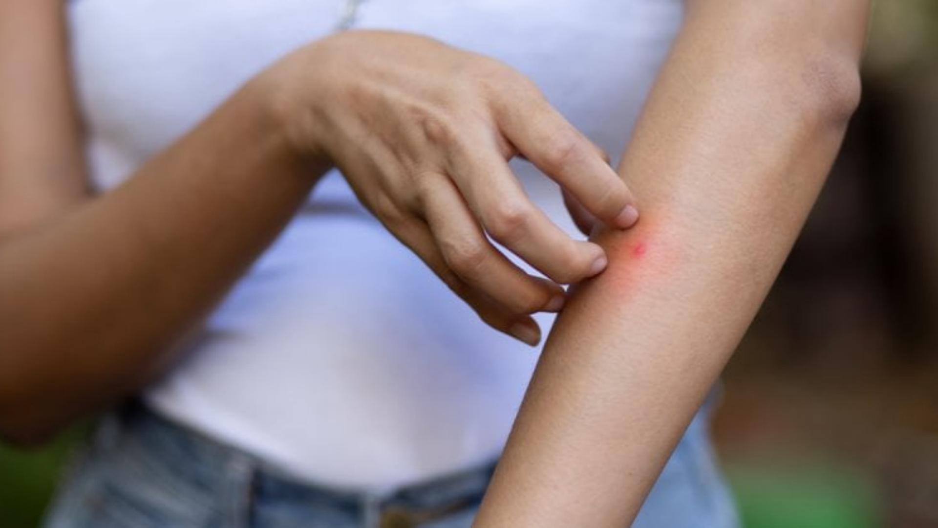 هلعٌ من الملاريا في لبنان... بين الرّعب والحقيقة!