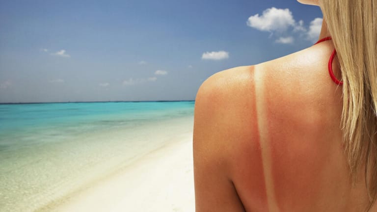 علاجات منزليّة لحروق الشمس