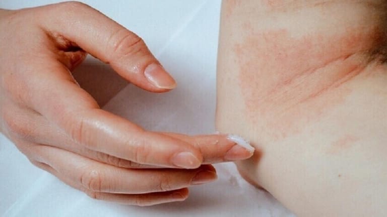 ما هو نوع الحساسيّة غير القابل للعلاج؟