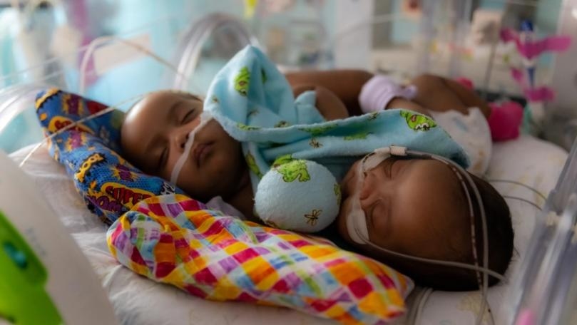 Conjoined Twins Separated in ‘Historic’ 11-Hour Surgery at Texas Hospital
