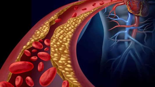 4 علامات لارتفاع مستويات الكوليسترول في الدم