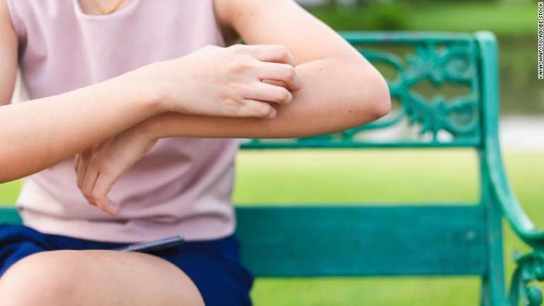 What Makes Mosquito Bites Itch and What to Do About It