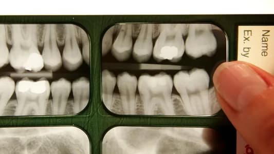 Primate Skull Study Explains Why Wisdom Teeth Grow so Late in Humans