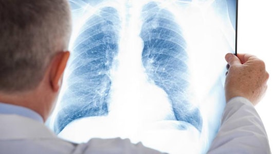 Recognizing the Symptoms of Lung Cancer: Common and Lesser Known Signs