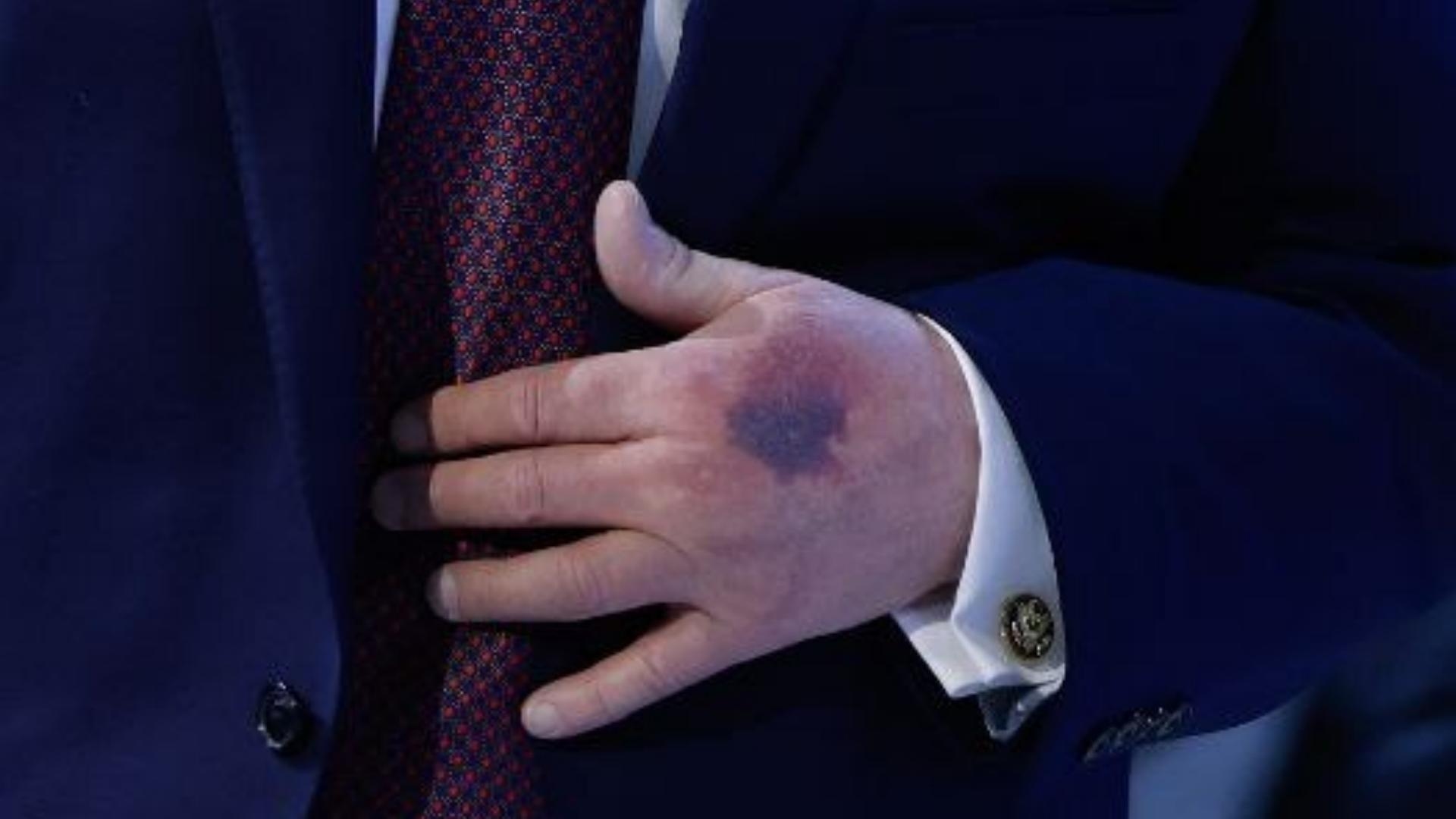 بالصّور: إليكم سبب الكدمات على يد ترامب