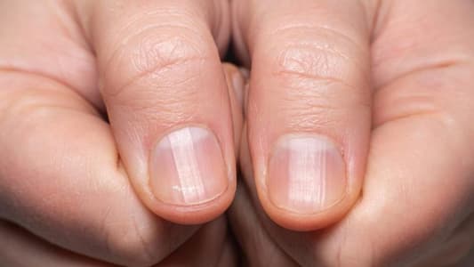 Scientist Warns 'Covid Nails' Could Be Sign You Had Coronavirus Before