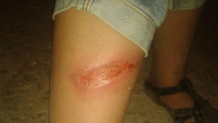 بالصّور: أحرق جسد ابنته امتعاضًا من ضجيجها!