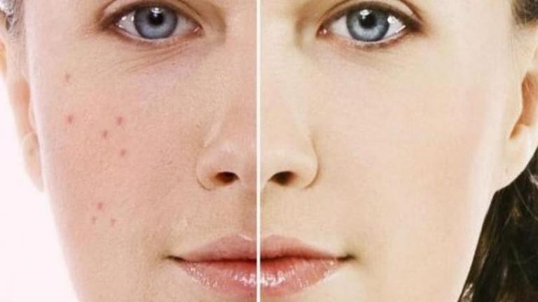 3 طرق لإزالة بقع الوجه بسرعة