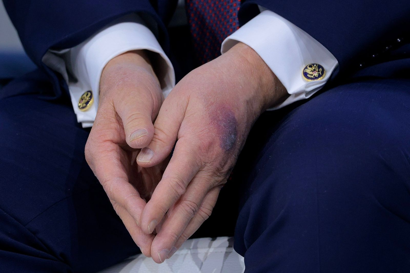 Photos: Large bruise on Trump’s hand raises questions