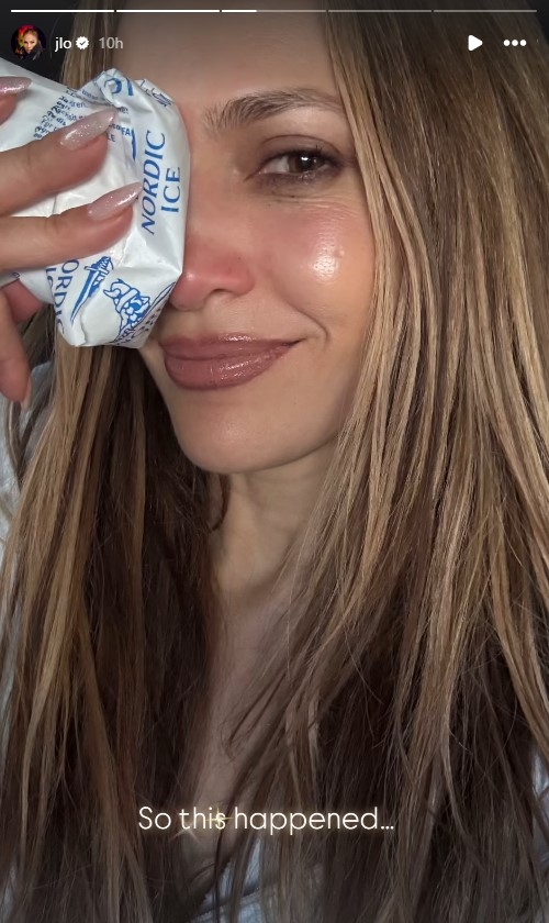 بالصور: إصابة جينيفر لوبيز في وجهها... ما السبب؟