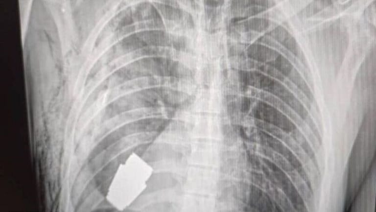 Ukrainian Doctors Remove Unexploded Grenade from Injured Soldier’s Chest