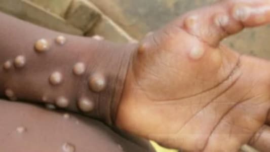 Saudi Public Health: The 'Type 1' monkeypox virus has not been detected in the Kingdom