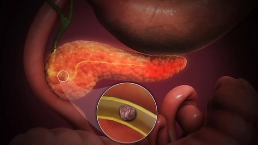 Understanding Acute and Chronic Pancreatitis: Causes, Symptoms, and Treatment