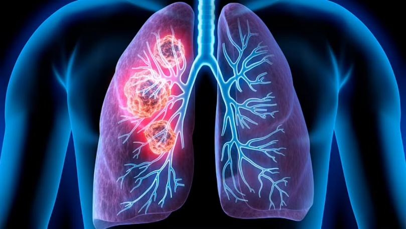 5 Myths about Lung Cancer Everyone Needs to Stop Believing
