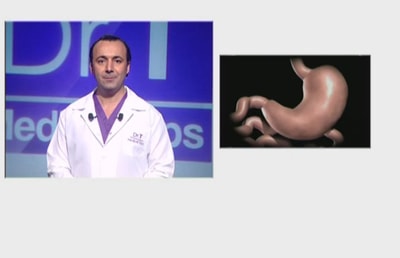 Sleeve Gastrectomy