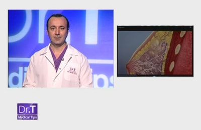 Breast Cancer