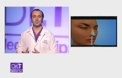 Rhinoplasty