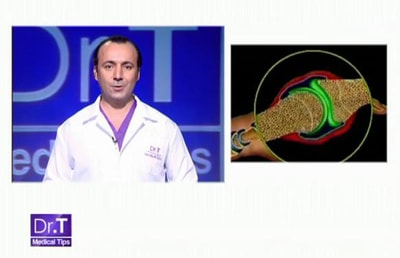 Arthrose 18 Jul 2013