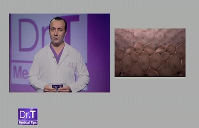 Psoriasis - 29 Jul 2013